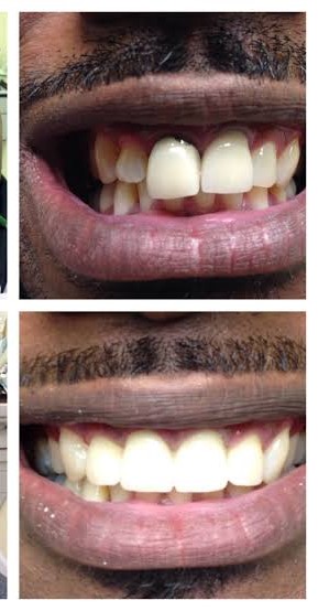 Prosthetic crown restoration before and after result